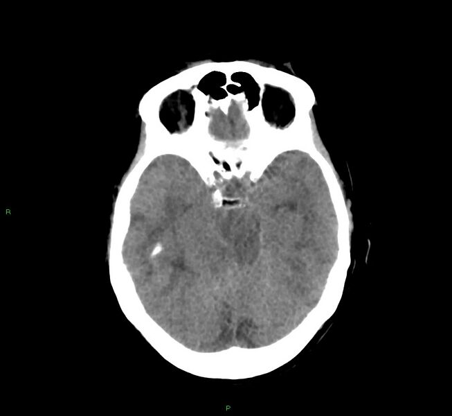 File:Cerebral amyloid angiopathy-associated lobar intracerebral hemorrhage (Radiopaedia 58751-65972 Axial non-contrast 33).jpg
