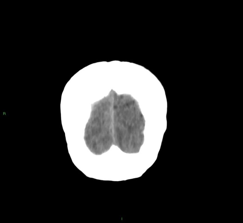 Cerebral amyloid angiopathy-associated lobar intracerebral hemorrhage (Radiopaedia 58751-65972 Coronal non-contrast 6).jpg