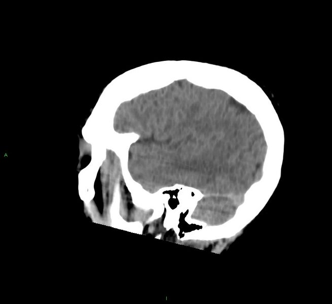 File:Cerebral amyloid angiopathy-associated lobar intracerebral hemorrhage (Radiopaedia 58756-65977 C 46).jpg