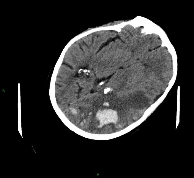 File:Cerebral amyloid angiopathy-associated lobar intracerebral hemorrhage (Radiopaedia 58757-65979 Axial non-contrast 57).jpg