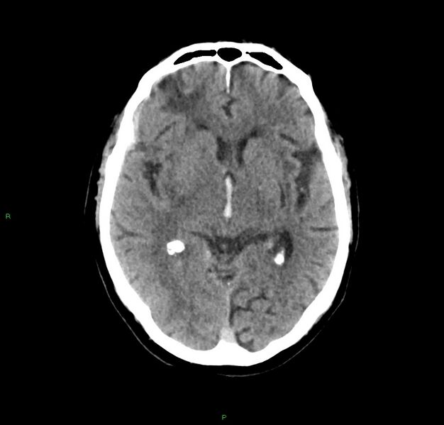 File:Cerebral amyloid angiopathy-associated lobar intracerebral hemorrhage (Radiopaedia 59356-66716 Axial non-contrast 26).jpg