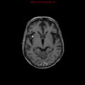 Cerebral and orbital tuberculomas (Radiopaedia 13308-13311 Axial T1 C+ 10).jpg