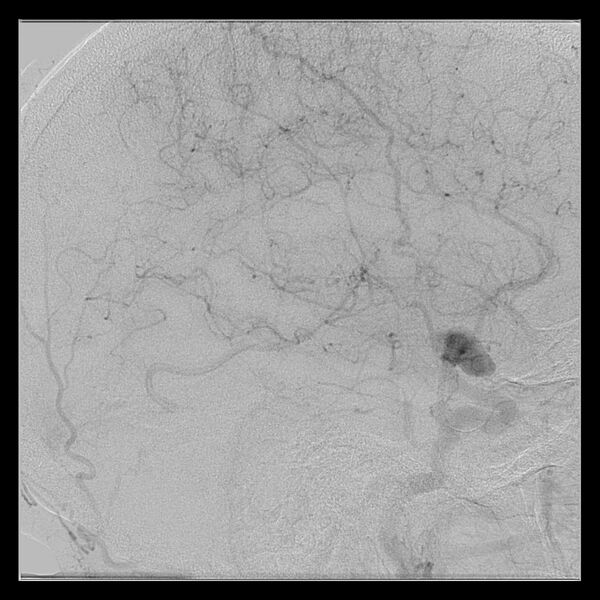 File:Cerebral aneurysm with rupture (Radiopaedia 29933-30458 LT ICA IC 45).jpg