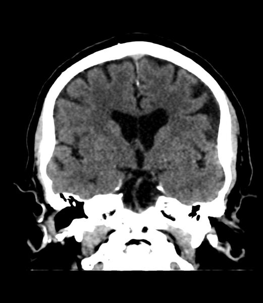 File:Cerebral dural venous sinus thrombosis (Radiopaedia 86514-102575 Coronal non-contrast 22).jpg