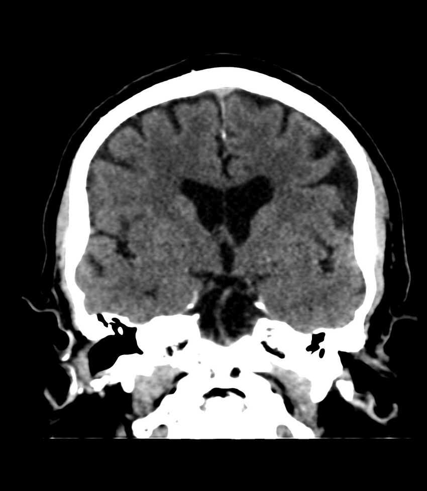 Cerebral dural venous sinus thrombosis (Radiopaedia 86514-102575 Coronal non-contrast 22).jpg