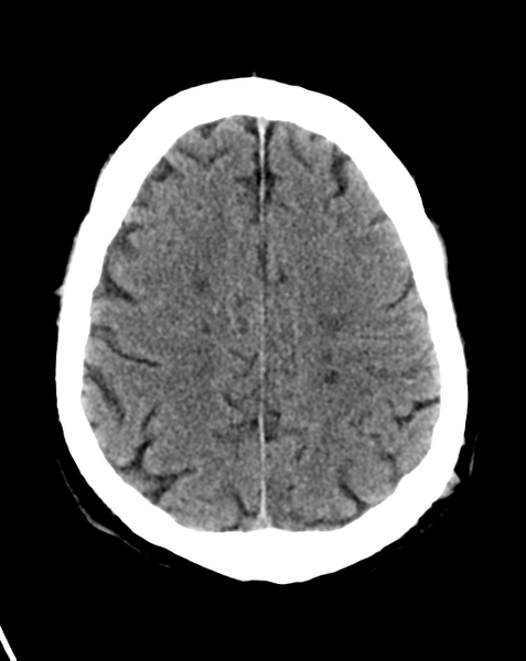 File:Cerebral embolic infarcts (embolic shower) (Radiopaedia 57395-64341 Axial non-contrast 23).png