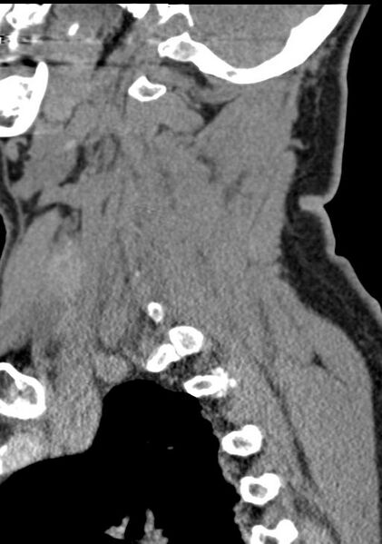 File:Cerebral hemorrhagic contusions and cervical spine fractures (Radiopaedia 32865-33841 G 82).jpg