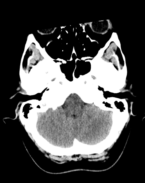 File:Cerebral venous infarct related to dural venous sinus thromboses (Radiopaedia 35292-36803 AXIAL THICK 5).png