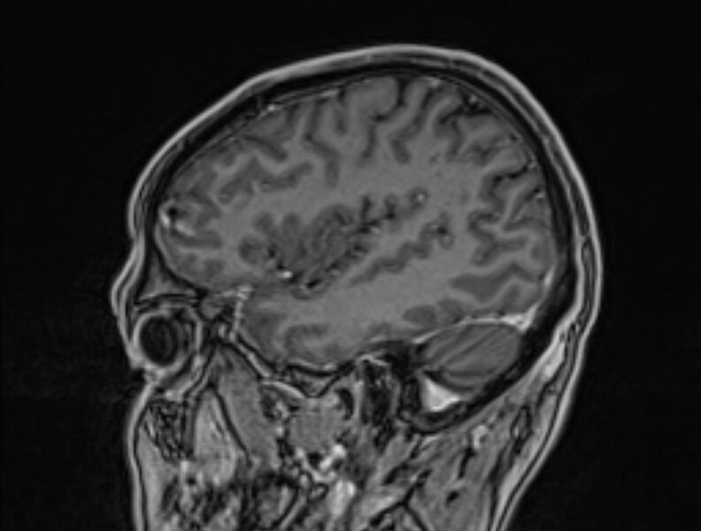 File:Cerebral venous thrombosis (Radiopaedia 71207-81504 Sagittal T1 C+ 50).jpg