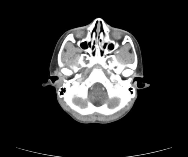 File:Cervical cystic lymphangioma (Radiopaedia 63655-72332 Axial + contrast 2).jpg
