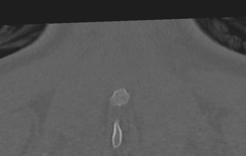File:Cervical disc replacement (Radiopaedia 37383-39205 Coronal bone window 62).png