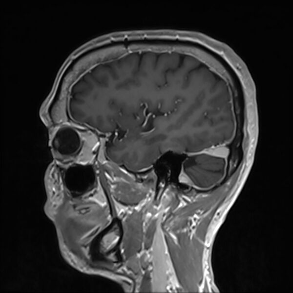 File:Cervical dural CSF leak on MRI and CT treated by blood patch (Radiopaedia 49748-54995 G 18).jpg