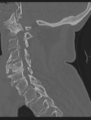 Cervical spondylolysis (Radiopaedia 49616-54811 Sagittal bone window 31).png