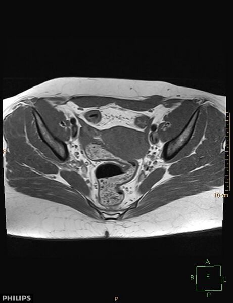 File:Cesarian scar endometriosis (Radiopaedia 68495-78066 Axial T1 11).jpg