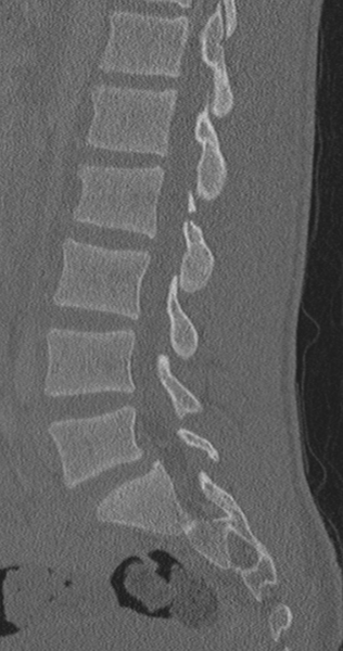 File:Chance fracture (Radiopaedia 40360-42912 Sagittal bone window 46).png