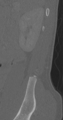 Chance fracture (Radiopaedia 40360-42912 Sagittal bone window 9).png