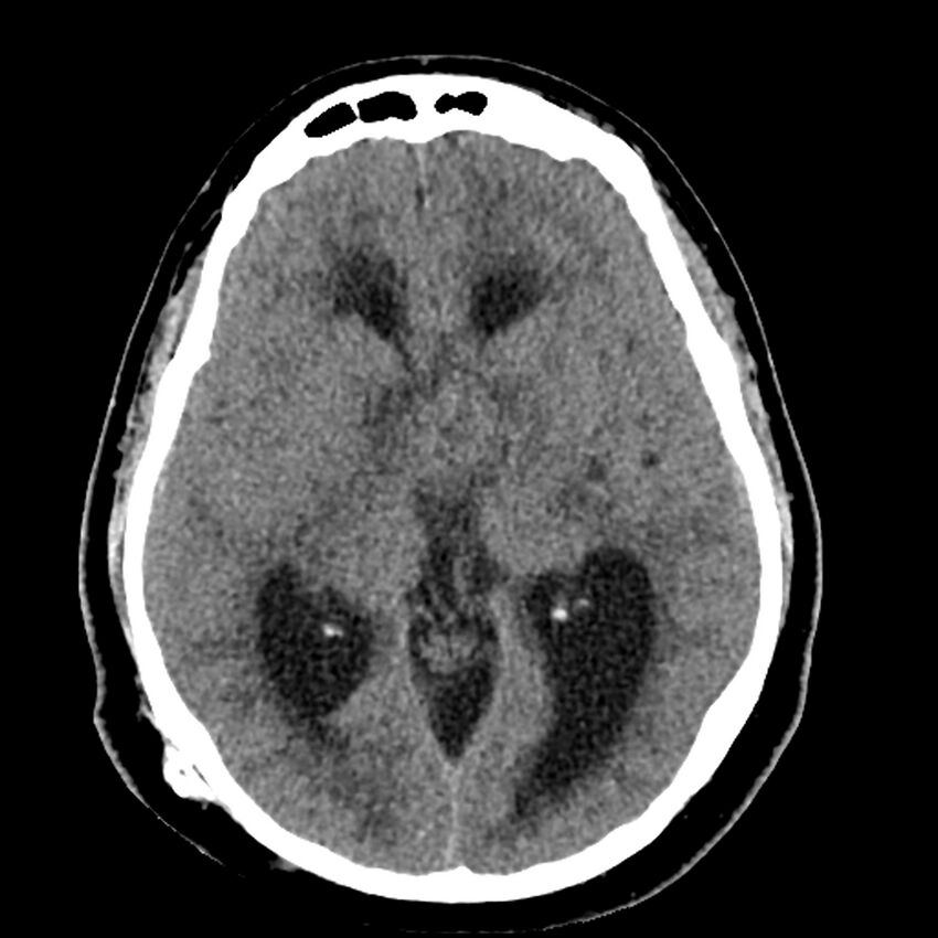 Chiasmatic-hypothalamic juvenile pilocytic astrocytoma (Radiopaedia 78533-91237 Axial non-contrast 28).jpg