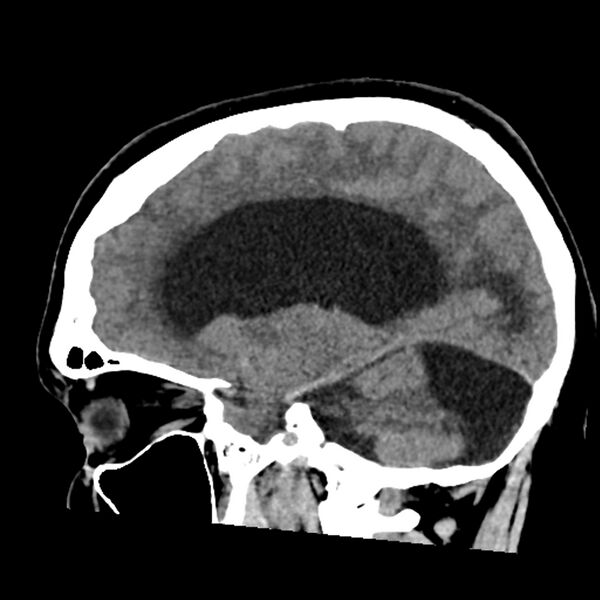 File:Chiasmatic-hypothalamic juvenile pilocytic astrocytoma (Radiopaedia 78533-91237 B 27).jpg