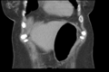 Cholecystitis - CT IVC obstructive choledocholitiasis (Radiopaedia 43966-47479 Coronal Biliscopin 11).png