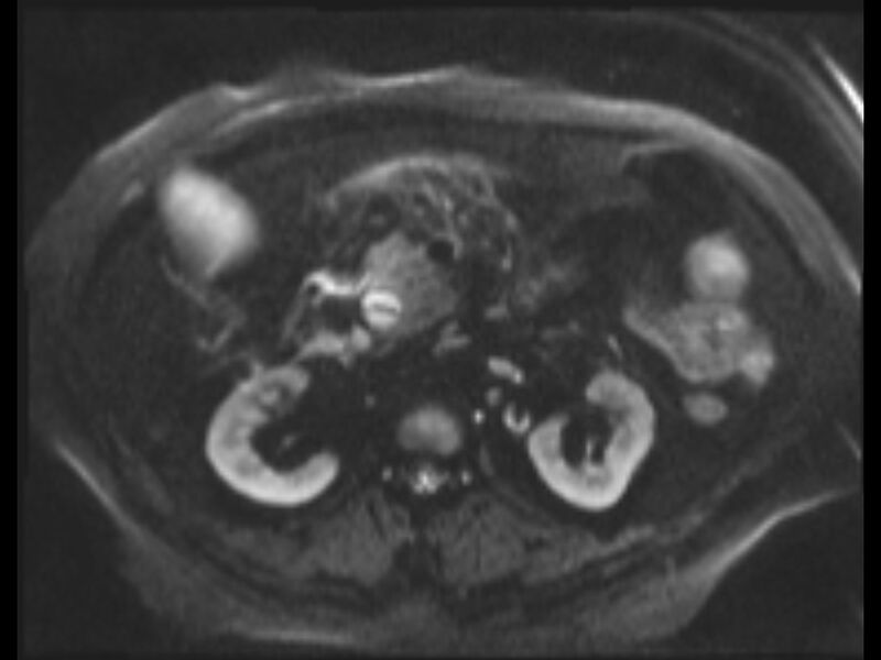 File:Choledocholithiasis causing intrahepatic biliary duct dilation (Radiopaedia 39908-42369 Axial T2 SPAIR 34).jpg