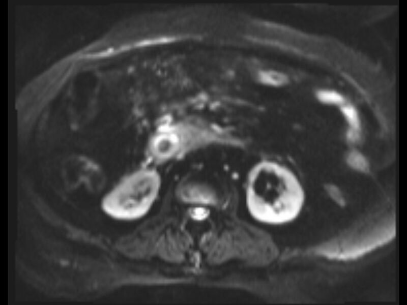 File:Choledocholithiasis causing intrahepatic biliary duct dilation (Radiopaedia 39908-42369 Axial T2 SPAIR 4).jpg