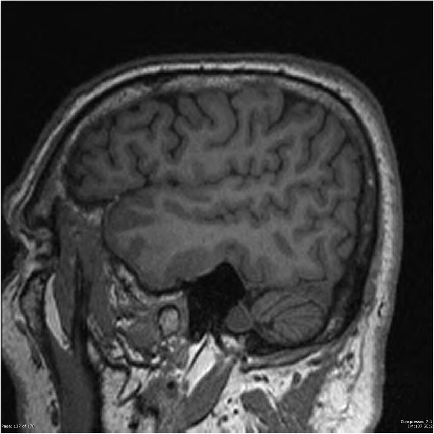 Chondrosarcoma of skull base- grade II (Radiopaedia 40948-43654 Sagittal T1 60).jpg