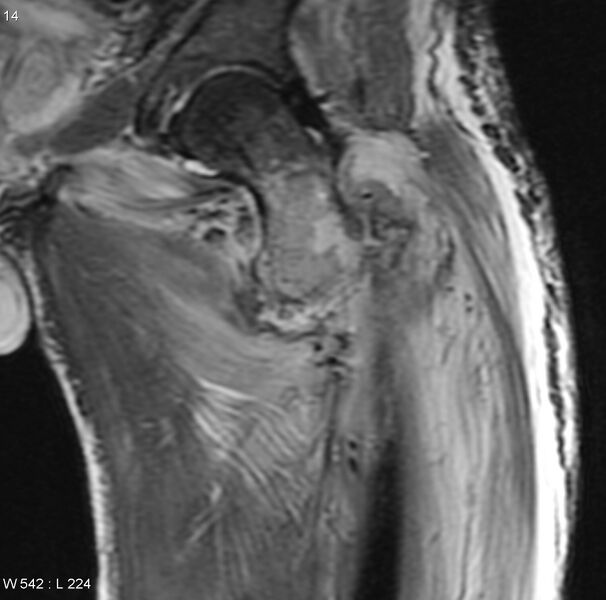 File:Chondrosarcoma with pathological fracture - femur (Radiopaedia 6174-7629 Coronal STIR 5).jpg