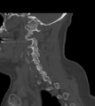 Chordoma (C4 vertebra) (Radiopaedia 47561-52188 Sagittal bone window 26).png