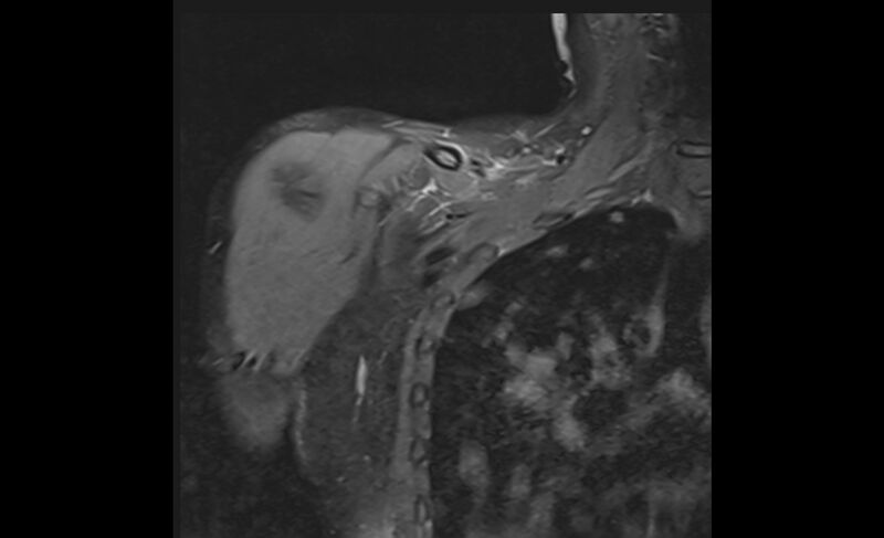 File:Choriocarcinoma in the shoulder (Radiopaedia 28603-28861 Coronal PD FS 2).jpg