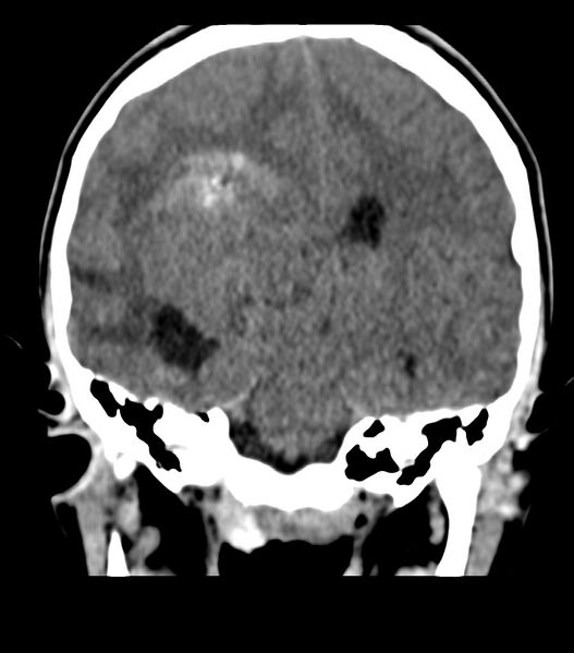File:Choroid plexus carcinoma (Radiopaedia 91013-108552 Coronal non-contrast 47).jpg