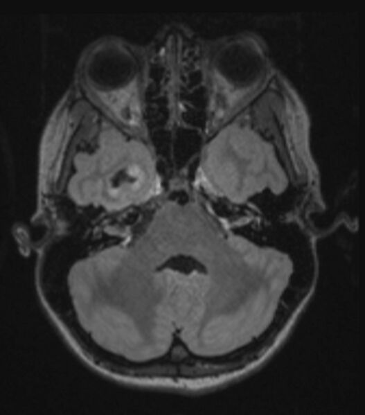 File:Choroid plexus carcinoma (Radiopaedia 91013-108553 Axial FLAIR C+ 96).jpg