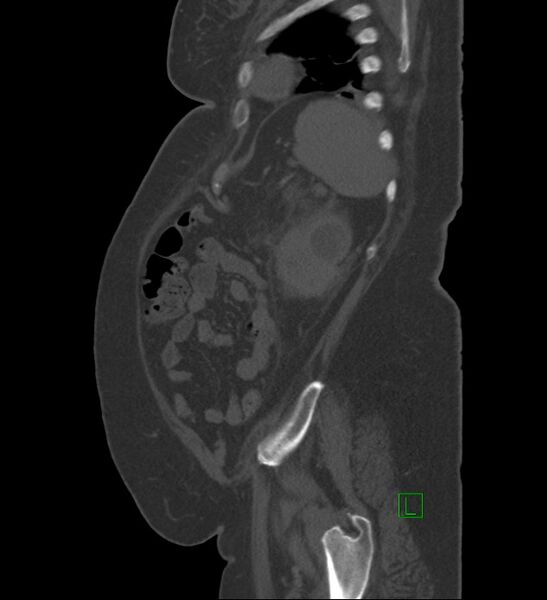 File:Chromophobe renal cell carcinoma (Radiopaedia 84239-99519 Sagittal bone window 18).jpg