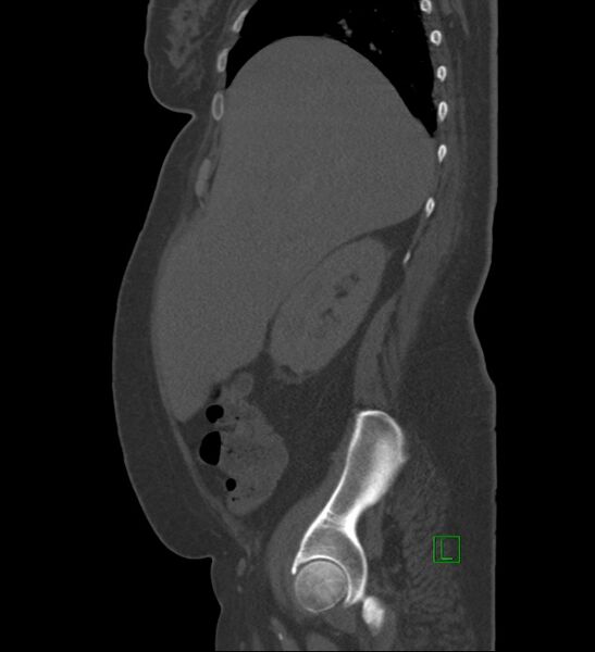 File:Chromophobe renal cell carcinoma (Radiopaedia 84239-99519 Sagittal bone window 81).jpg