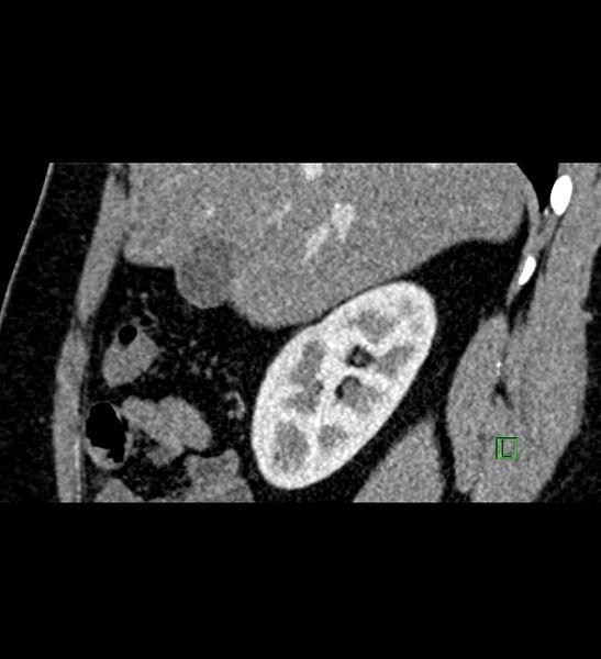 File:Chromophobe renal cell carcinoma (Radiopaedia 84286-99573 F 125).jpg