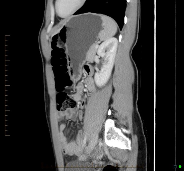 File:Chronic abscess due to "dropped" appendicoliths following appendectomy for perforated appendix (Radiopaedia 58805-66344 D 19).jpg