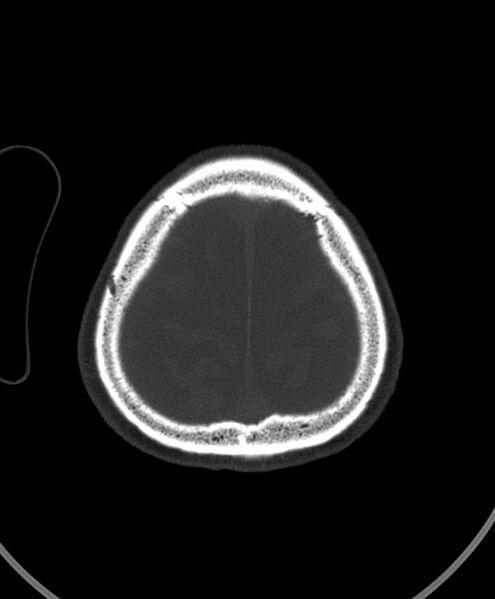 File:Chronic bilateral subdural hygroma (Radiopaedia 85801-101623 Axial bone window 24).jpg