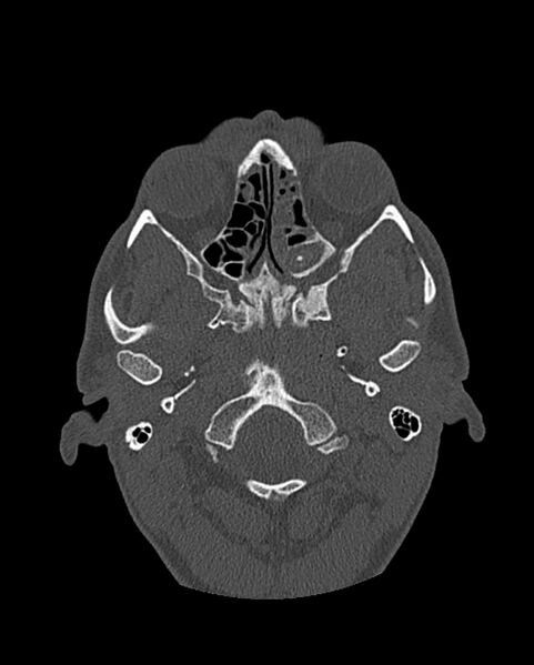 File:Chronic maxillary sinusitis caused by a foreign body (Radiopaedia 58521-65676 Axial bone window 184).jpg