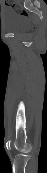 File:Chronic osteomyelitis (with sequestrum) (Radiopaedia 74813-85822 C 68).jpg