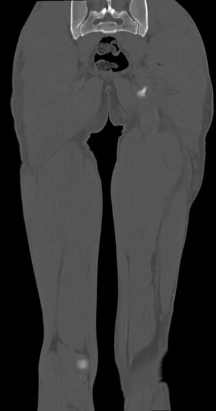 File:Chronic osteomyelitis (with sequestrum) (Radiopaedia 74813-85822 Coronal non-contrast 45).jpg