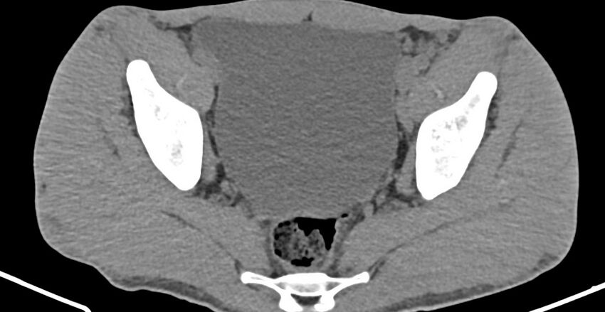 Chronic osteomyelitis (with sequestrum) (Radiopaedia 74813-85822 D 25).jpg