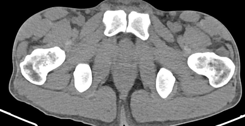 Chronic osteomyelitis (with sequestrum) (Radiopaedia 74813-85822 D 46).jpg