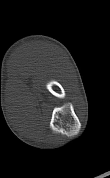 File:Chronic osteomyelitis of the distal humerus (Radiopaedia 78351-90971 Axial 64).jpg