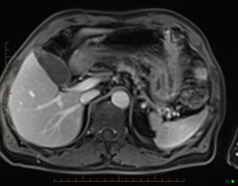 File:Chronic pancreatitis (Radiopaedia 17014-16716 Axial T1 C+ fat sat 19).jpg