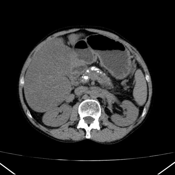 File:Chronic pancreatitis (Radiopaedia 23132-23172 Axial non-contrast 29).jpg