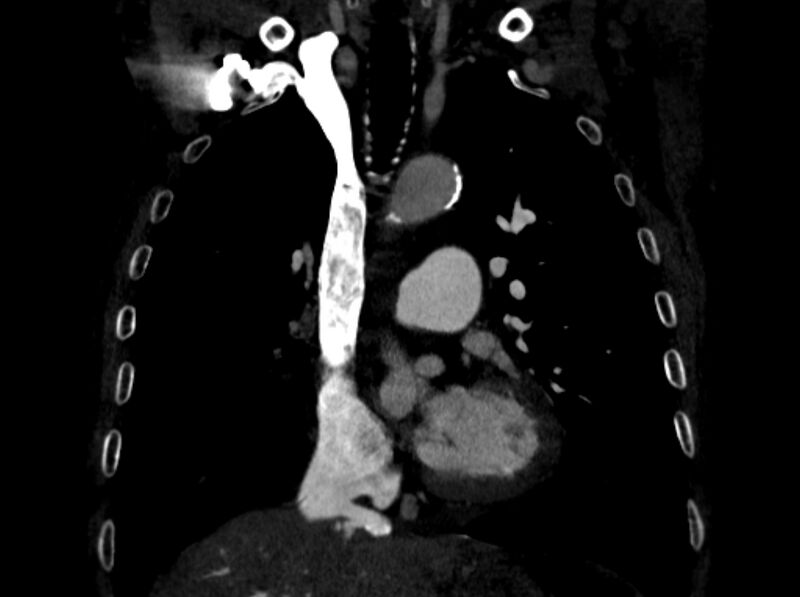 File:Chronic pulmonary embolism (Radiopaedia 91241-108843 A 44).jpg