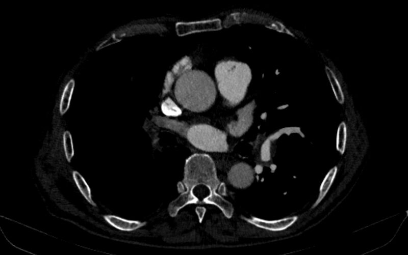 File:Chronic pulmonary embolism (Radiopaedia 91241-108843 B 99).jpg