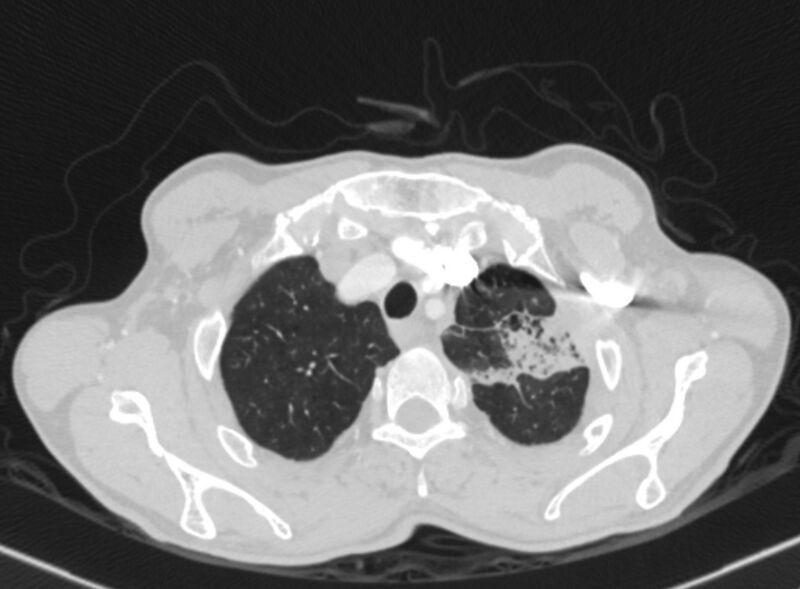File:Chronic pulmonary embolism with bubbly consolidation (Radiopaedia 91248-108850 Axial lung window 20).jpg