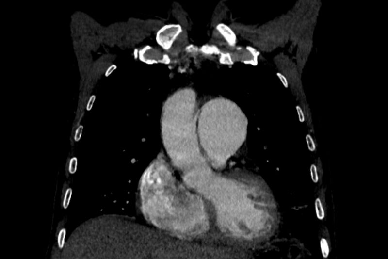 File:Chronic pulmonary embolism with bubbly consolidation (Radiopaedia 91248-108850 B 44).jpg