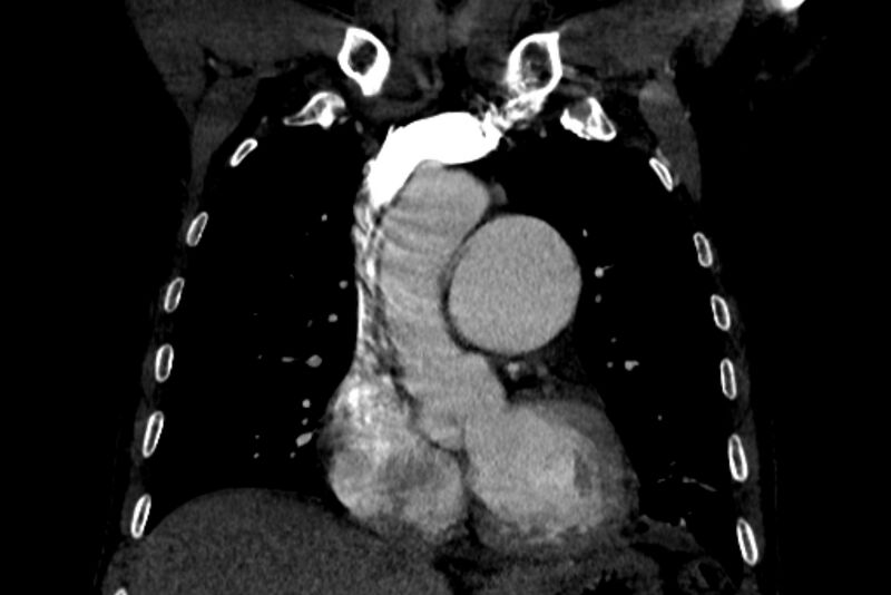 File:Chronic pulmonary embolism with bubbly consolidation (Radiopaedia 91248-108850 B 54).jpg