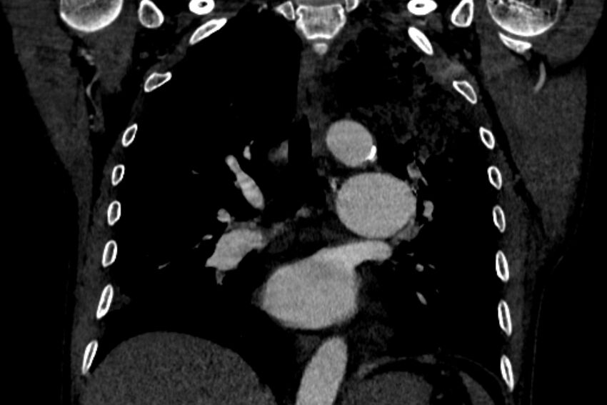 Chronic pulmonary embolism with bubbly consolidation (Radiopaedia 91248-108850 B 82).jpg